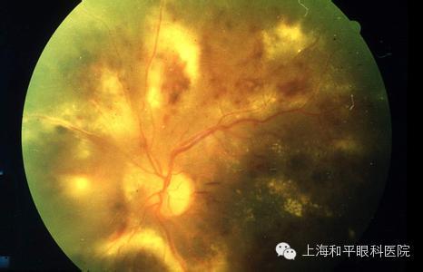 高度近視易發(fā)生眼底病變