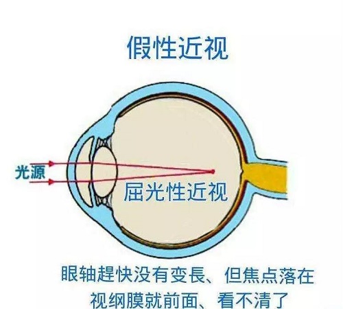 什么是假性近視？