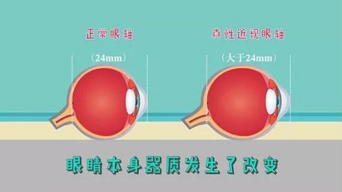 什么是真性近視？