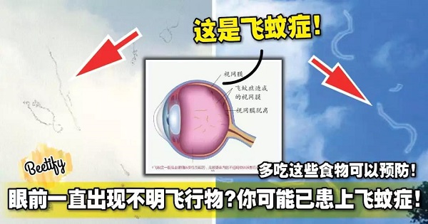 哪些人易患飛蚊癥？