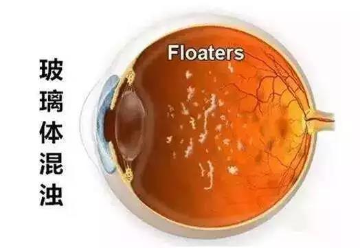 哪些人易患飛蚊癥？