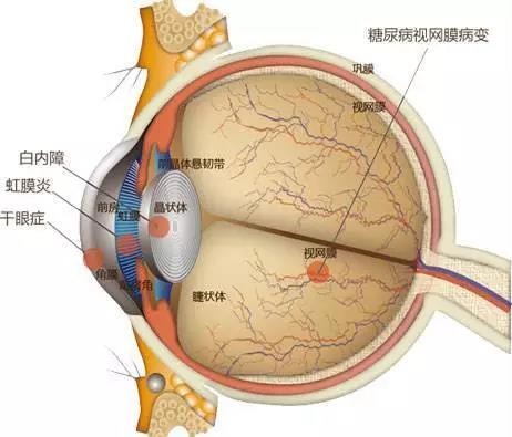 糖網(wǎng)病有哪些癥狀？