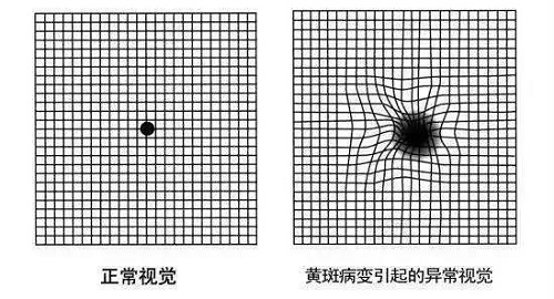 如何自測是否患有黃斑變性？