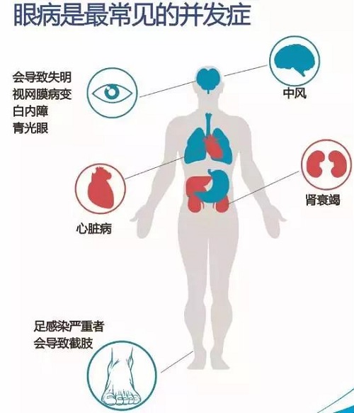糖尿病會引起哪些并發(fā)癥？