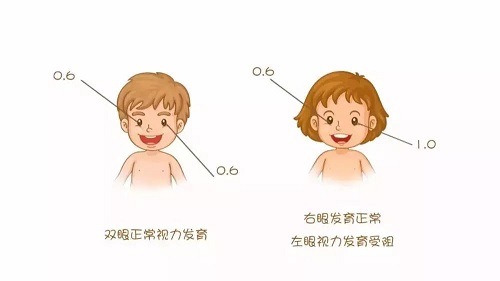 什么是弱視？