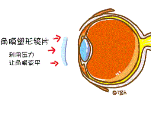 冬季如何保養(yǎng)角膜塑形鏡？