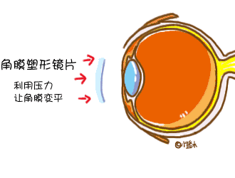 造成孩子近視的原因有哪些？