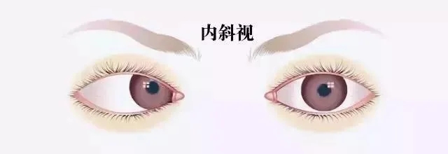 什么是斜視？