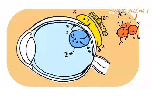 近視度數(shù)增長過快可以做后鞏膜加固術(shù)
