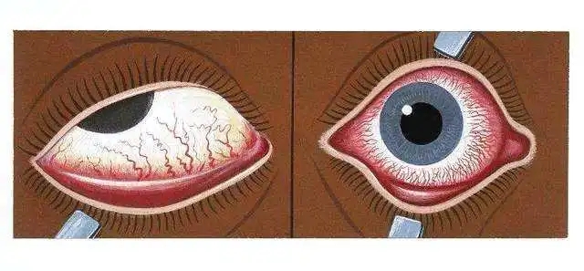 眼睛分泌物增多是怎么回事？