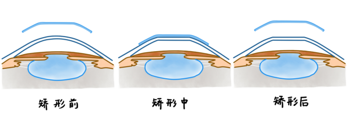 如何正確佩戴角膜塑形鏡？