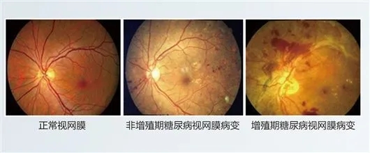 高糖油膩食物會(huì)造成糖尿眼病嗎？