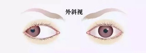 孩子眼睛有時候斜，有時候不斜，需要治療嗎？