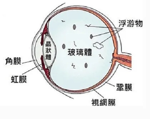 得了飛蚊癥有必要治療嗎？
