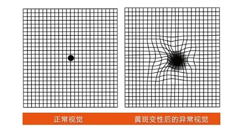 看東西總覺得變形是怎么回事？