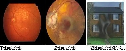 看東西總覺得變形是怎么回事？