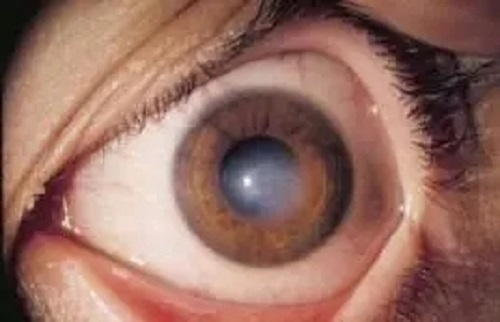 什么是角膜白斑？