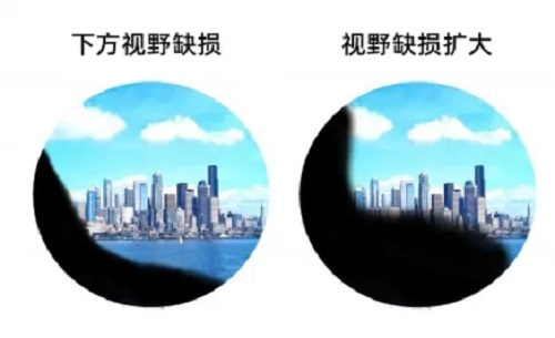 哪些人容易患視網(wǎng)膜脫落？