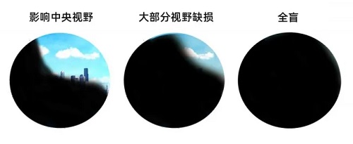哪些人容易患視網(wǎng)膜脫落？