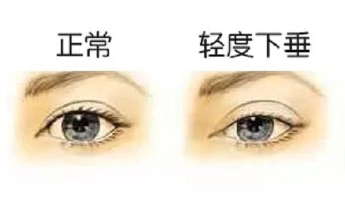 眼皮下垂是上瞼下垂嗎？