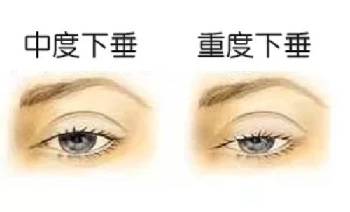 眼皮下垂是上瞼下垂嗎？