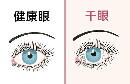如何預(yù)防干眼？