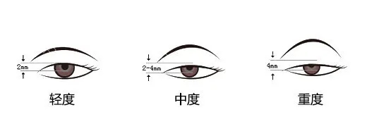 眼睛小是上瞼下垂造成的嗎？