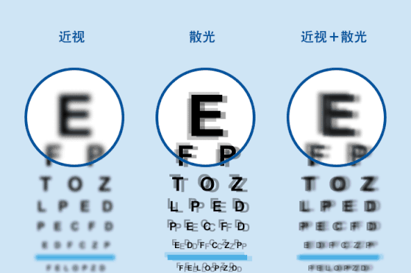 近視散光