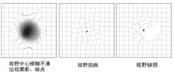 黃斑變性